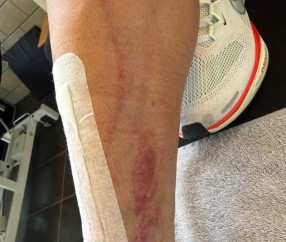 体育赛事-慎入！前德甲球员霍尔特比荷甲遭遇凶狠犯规，脚被划开一道口子