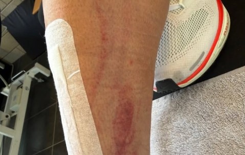 体育赛事-慎入！前德甲球员霍尔特比荷甲遭遇凶狠犯规，脚被划开一道口子